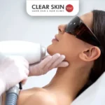 Laser Hair Removal Near Me