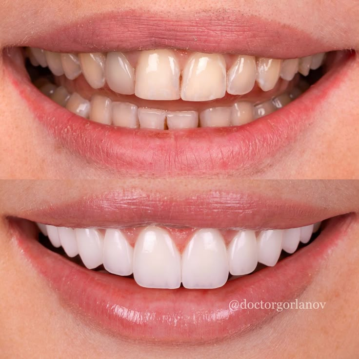 pictures of teeth without enamel