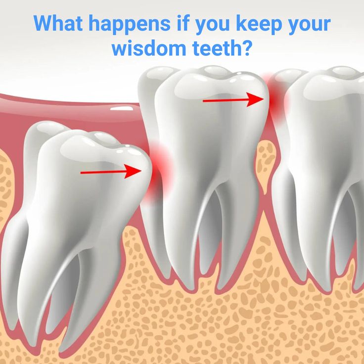 when can i eat after wisdom teeth removal