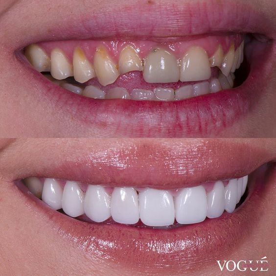 shaved teeth for veneers